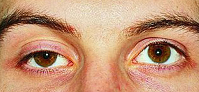 Enophthalmos - Eyes Alive