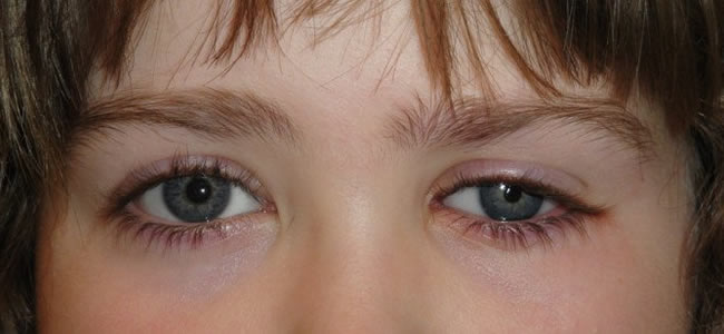 Enophthalmos - Eyes Alive