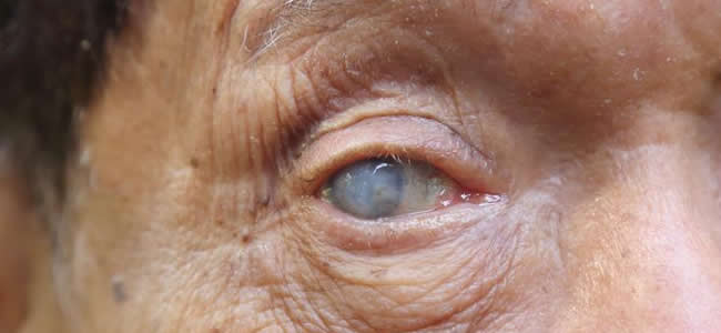 Enophthalmos - Eyes Alive